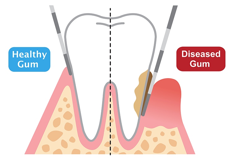 Illustration comparing a healthy gum and a diseased gum around a tooth, showing gum recession and plaque buildup on the diseased side.