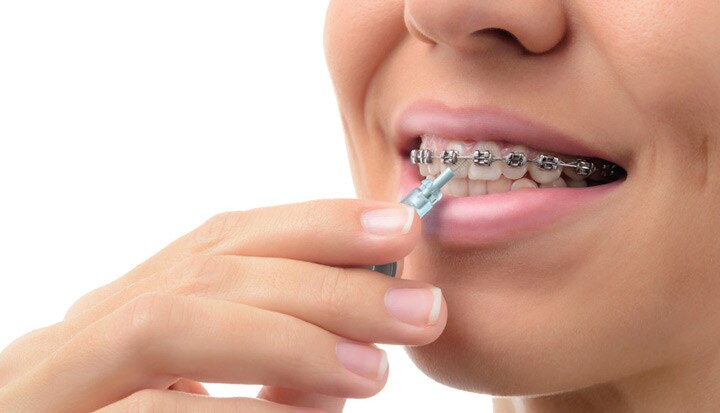 Oral Care during Orthodontic treatmen