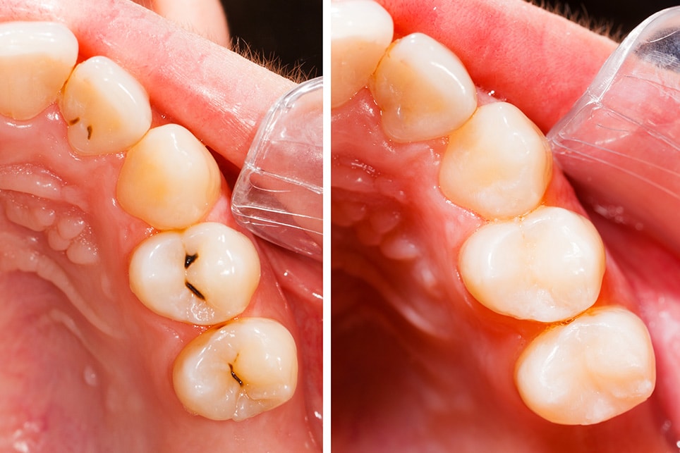 Teeth before and after treatment 