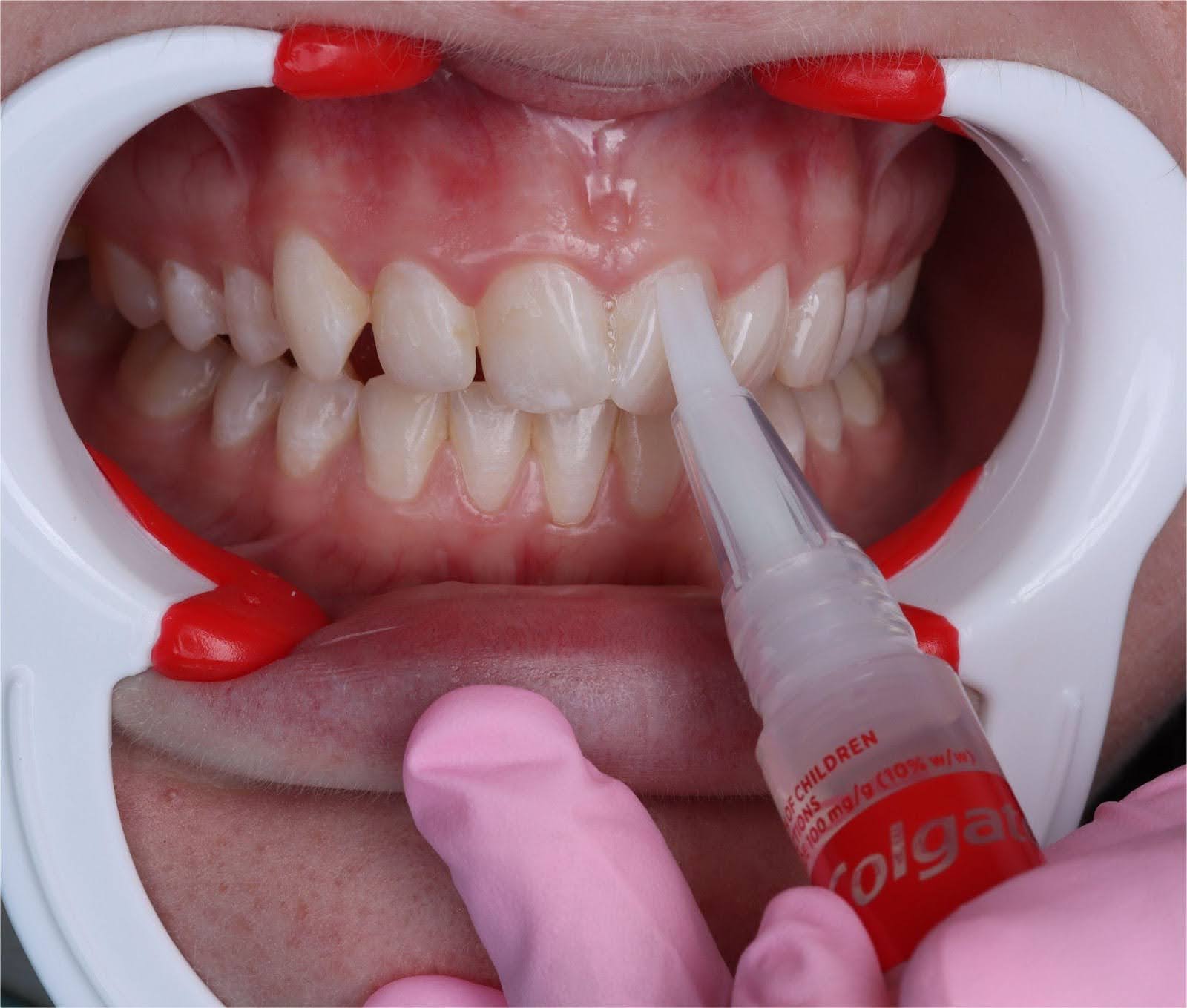 The whitening gel applied directly to the tooth surfaces without the need for gingival barriers