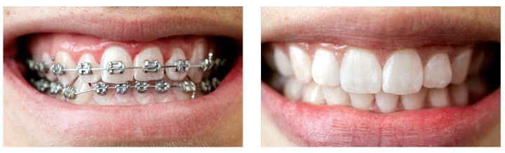 Oral Care During Orthodontic Treatment