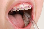 Oral Care during Orthodontic treatmen