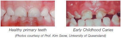 Healthy Primary teeth