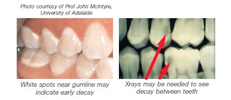 white spots near gumline
