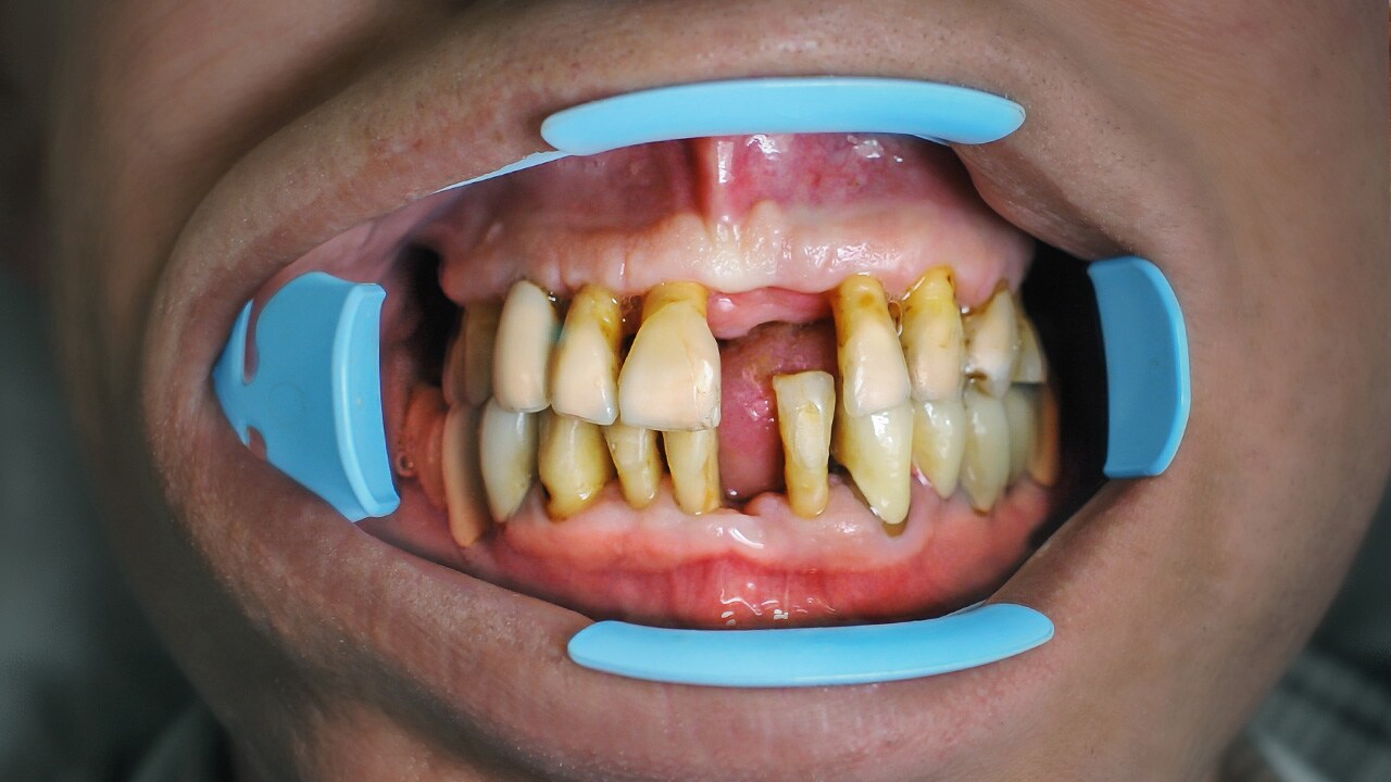 Gum Recession