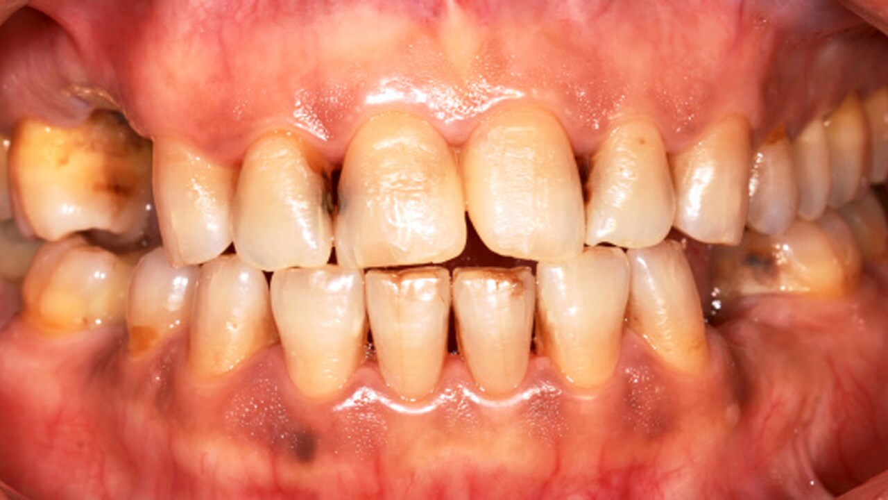 Root Caries