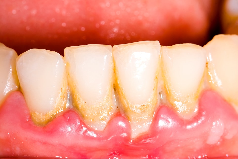 man with plaque on his teeth